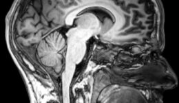 MRI_brain_sagittal_section