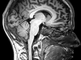 MRI_brain_sagittal_section